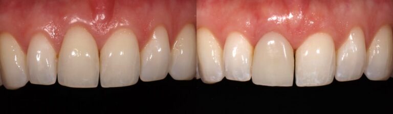 Before and after: A step-by-step approach to immediate implants