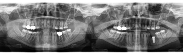 Before and after: Immediate implants