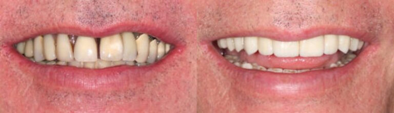 Before and after: All-on-4 Implants