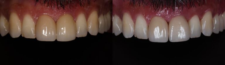 Before and after: Immediate implant for a front tooth