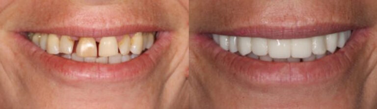 Before and after: All-on-4 Dental Implants