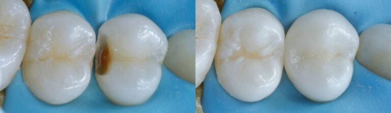 Before and after: Composite Filling