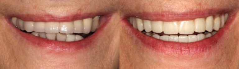 Before and after: All-on-4