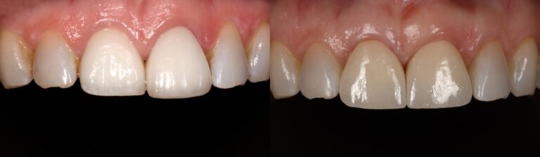 Before and after: Immediate implant and crown for two front teeth
