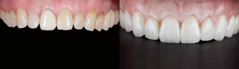 Before and after: Porcelain Veneers