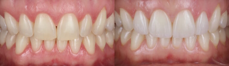 Before and after: Porcelain Veneers
