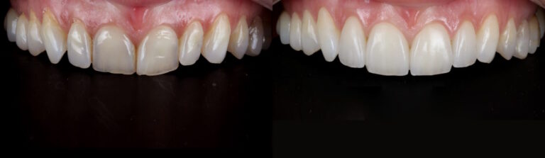 Before and after: Porcelain Veneers