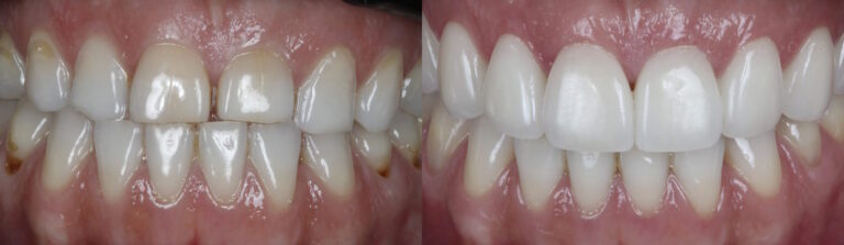 Before and after: Porcelain Veneers