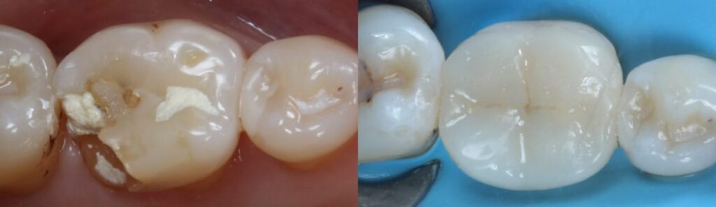 Before and after: Organic Inlays