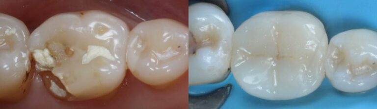 Before and after: Organic Inlays