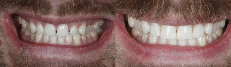 Before and after: Composite Veneers