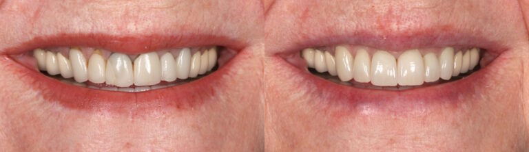 Before and after: Crowns