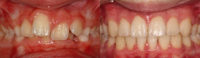 Before and after: Maryland Bridges