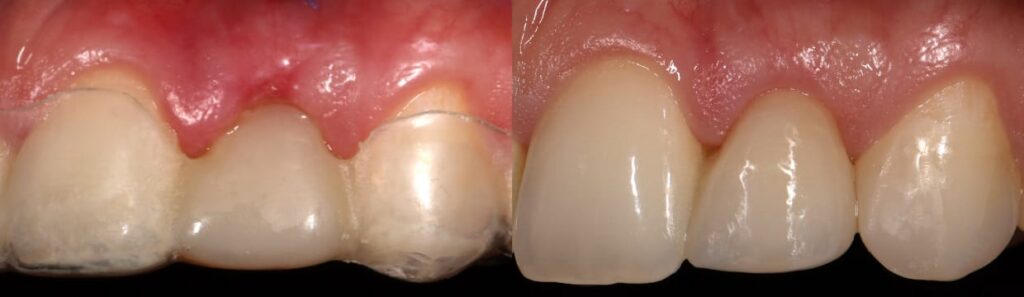 Before and after: A step-by-step approach to immediate implants