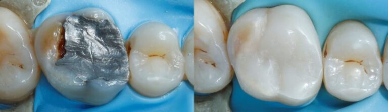 Before and after: Composite Filling