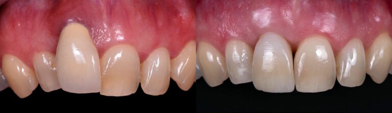 Before and after: Orthodontics and single-tooth implant