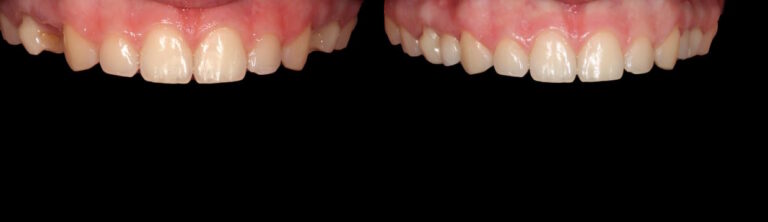 Before and after: Adhesive bridges and baby teeth to replace missing teeth