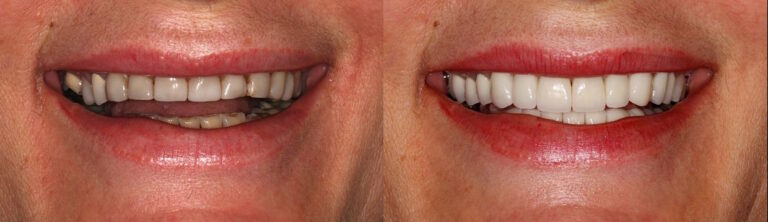 Before and after: Aesthetic treatment with veneers