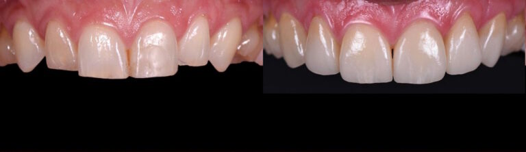 Before and after: Aesthetic treatment with veneers