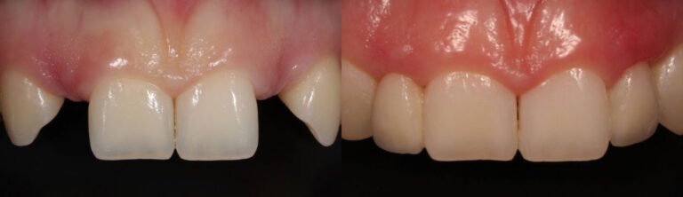 Before and after: All-ceramic adhesive bridges (Maryland bridges) in the upper jaw