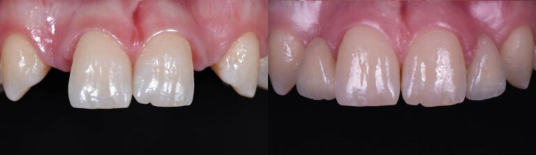 Before and after: All-ceramic adhesive bridges (Maryland bridges) in the upper jaw