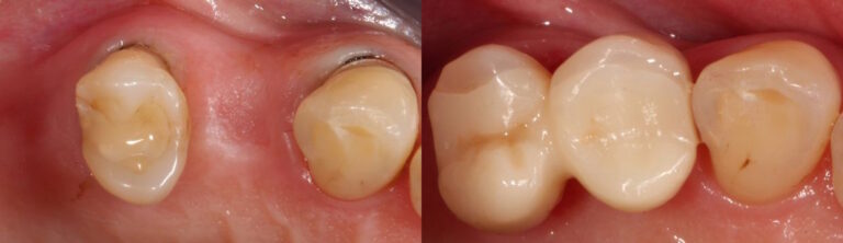 Before and after: All-ceramic adhesive bridges (Maryland bridges) replacing missing posterior teeth