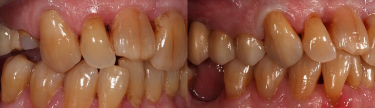 Before and after: All-ceramic conventional bridge