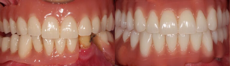 Before and after: All-on-4