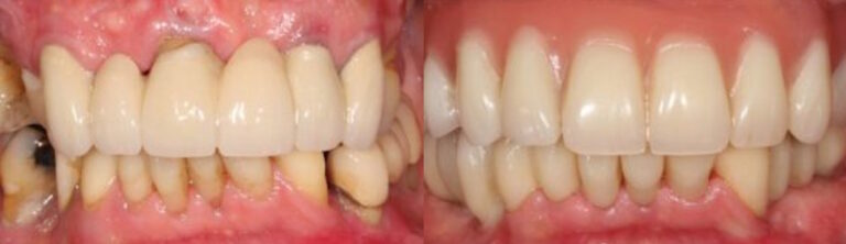 Before and after: All-on-4