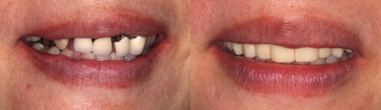 Before and after: All-on-4 Dental Implants