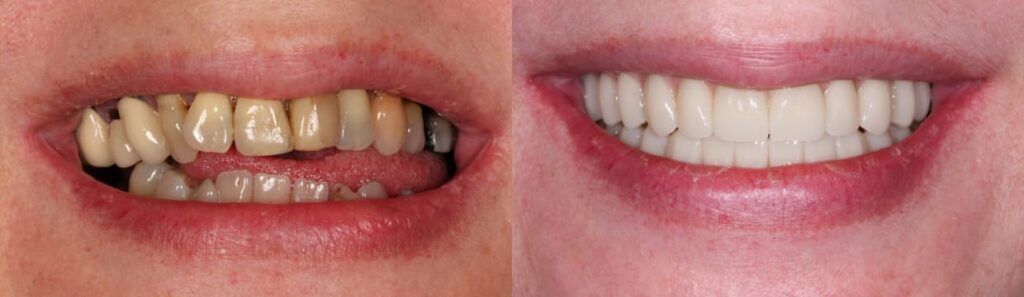 Allon4 Before After