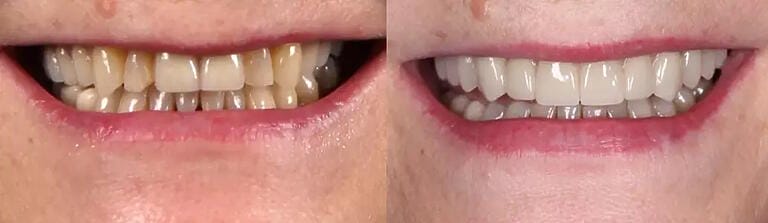 Before and after: All-on-4 Dental Implants