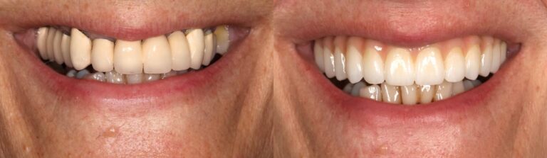 Before and after: Upper Jaw All-on-4