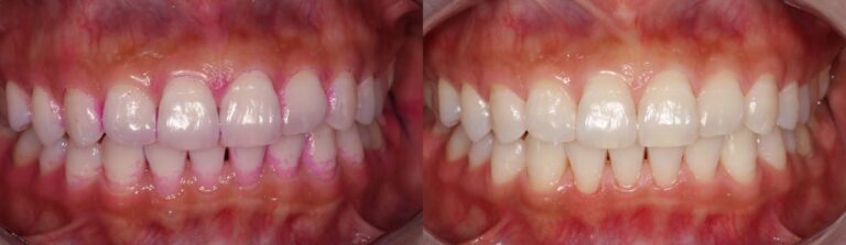 Before and after: Dental Hygiene Deep Clean