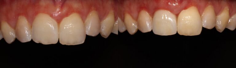 Before and after: Immediate implant for central incisor