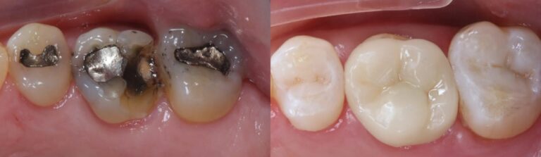 Before and after: Organic Inlays