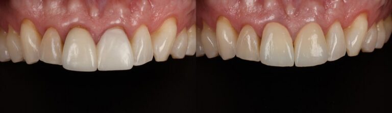 Before and after: Full Ceramic Crowns