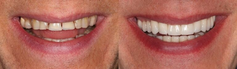 Before and after: Full mouth reconstruction