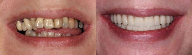 Before and after: Restoration of a dentition with implants