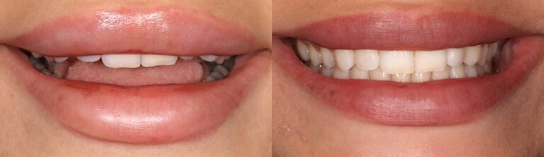 Before and after: Invisalign/Composite Bonding