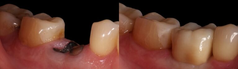 Before and after: Immediate implants