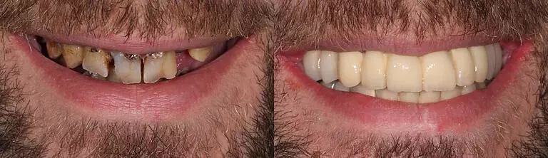 Before and after: All-on-6/All-on-4