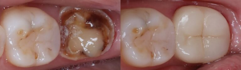 Before and after: Organic Inlays