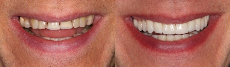 Before and after: Full mouth reconstruction