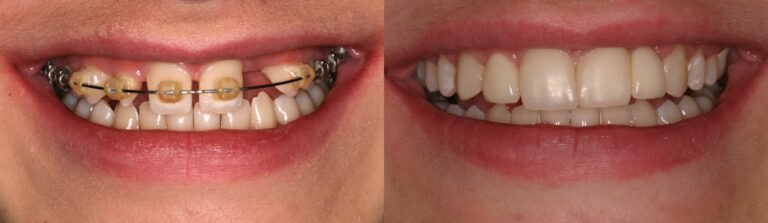 Before and after: Maryland Bridges