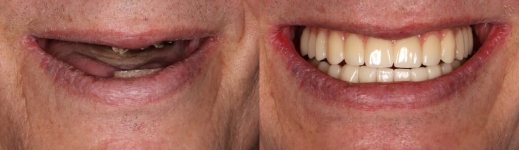 Before and after: Upper and Lower Jaw All-on-4