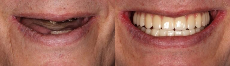 Before and after: Upper and Lower Jaw All-on-4