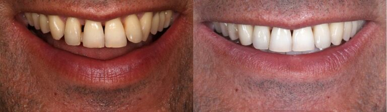 Before and after: Periodontitis and Immediate implants to replace lower front teeth