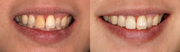 Before and after: Internal whitening of an upper jaw front tooth