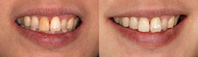 Internal whitening of an upper jaw front tooth before and after